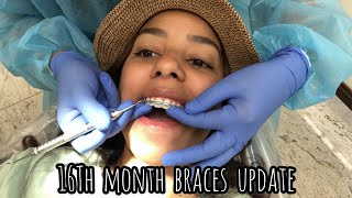 16th Month braces update, last round of IPR |Slayitvida