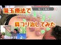 吸い玉療法やってみた #カッピング #佐賀市 #肩こり解消