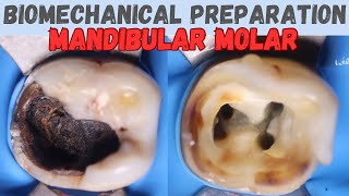 Biomechanical Preparation in Mandibular Molar 🟡 mandibular first molar ⚪️ step by step demonstration