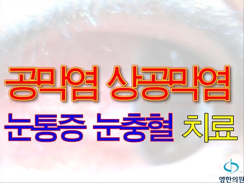 공막염 상공막염 눈통증 눈충혈 치료