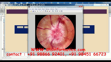 Diabetic Retinopathy Detection Using Image Processing | IEEE | Matlab Project | Image Processing