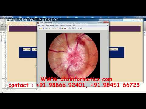 Diabetic Retinopathy Detection Using Image Processing | IEEE | Matlab Project | Image Processing