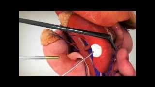 Kidney Cryotherapy | Dr. McDonald | Urology Center of Central Florida