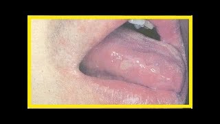 Leucocitoclástica por hipersensibilidade o vasculite que é
