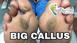 BIG Calluses on Both Feet | Healthy Feet Podiatry of Tampa and Wesley Chapel 
