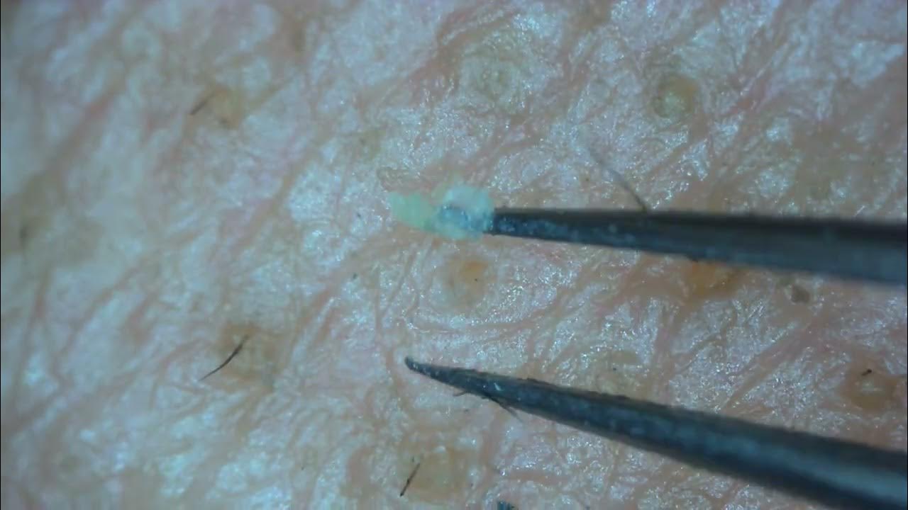 0192 keratin plug removal cheek YouTube