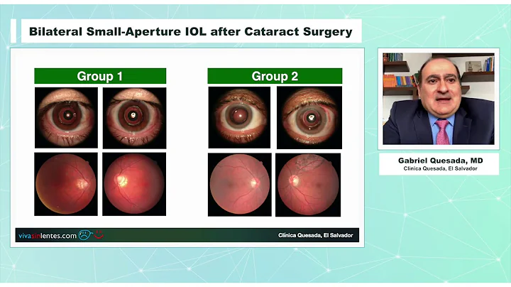 Bilateral Small-Aperture IOL after Cataract Surgery  | EYE NEWS TV