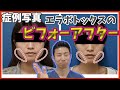 小顔ボトックス（エラボトックス）の動画