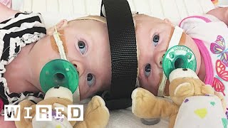 Surgeons Break Down Separating Conjoined Twins | WIRED