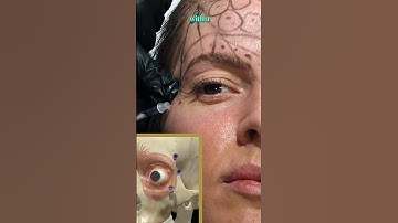 My technique for injecting toxin close to the eye