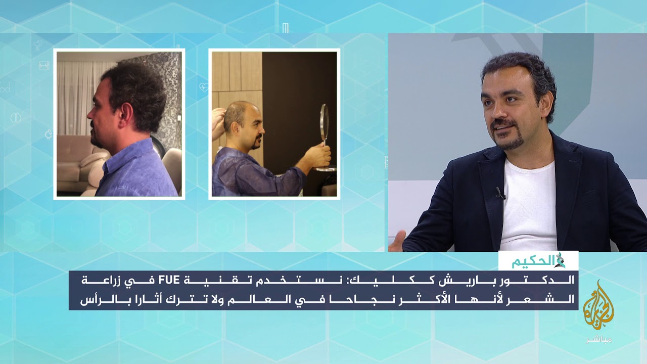 شاهد قبل وبعد عملية زراعة الشعر