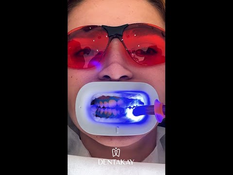 Amazing Teeth whitening