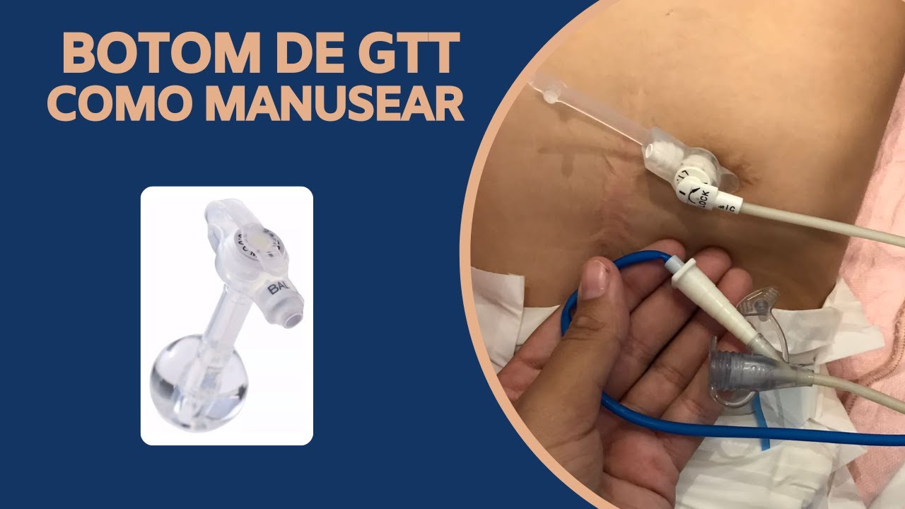 GASTROSTOMIA NA PRÁTICA