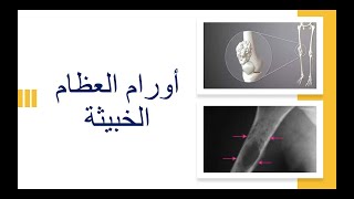Bone tumors / أورام العظام الخبيثة