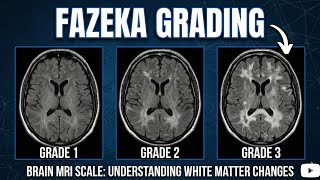 Fazekas grading and physiotherapy relevance