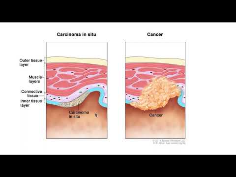Vidéo: Carcinome canalaire in situ icd 10 ?