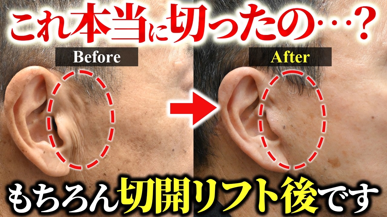 Look Like a New Person] Dramatic Improvement in Smile Lines! Case