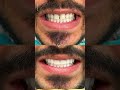 Veneers Before and After - GYA Dental Center Dubai