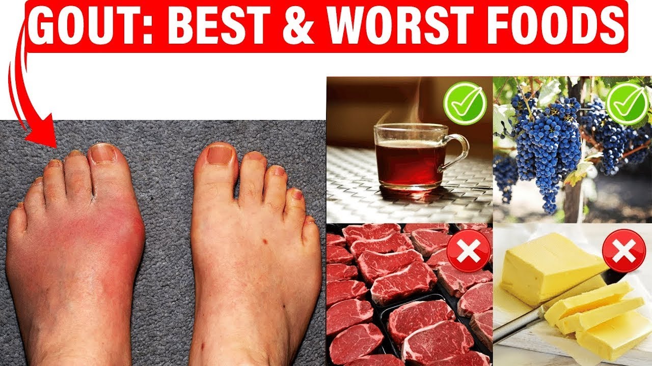 ?Best Gout Diet & Foods To Avoid? [Uric Acid Foods That Cause Gout!] -  Youtube