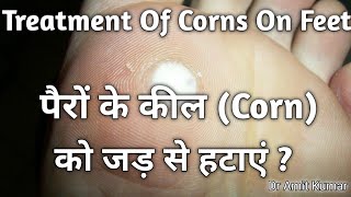 Treatment Of Corns On Feet | पैरों के कील को जड़ से हटाएं? पैरों के कील का इलाज!