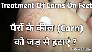 Treatment Of Corns On Feet | पैरों के कील को जड़ से हटाएं? पैरों के कील का इलाज!