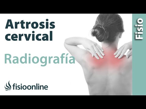 Vídeo: Artritis De Espalda Y Cuello: Síntomas De Artritis Facetaria Y Dolor De Espalda