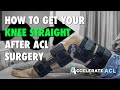 How To Get Your Knee Straight After ACL Surgery