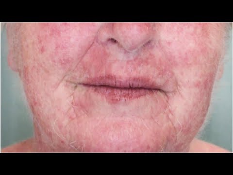 Are These Tiny Bumps on My Face an Allergic Reaction? | Tita TV