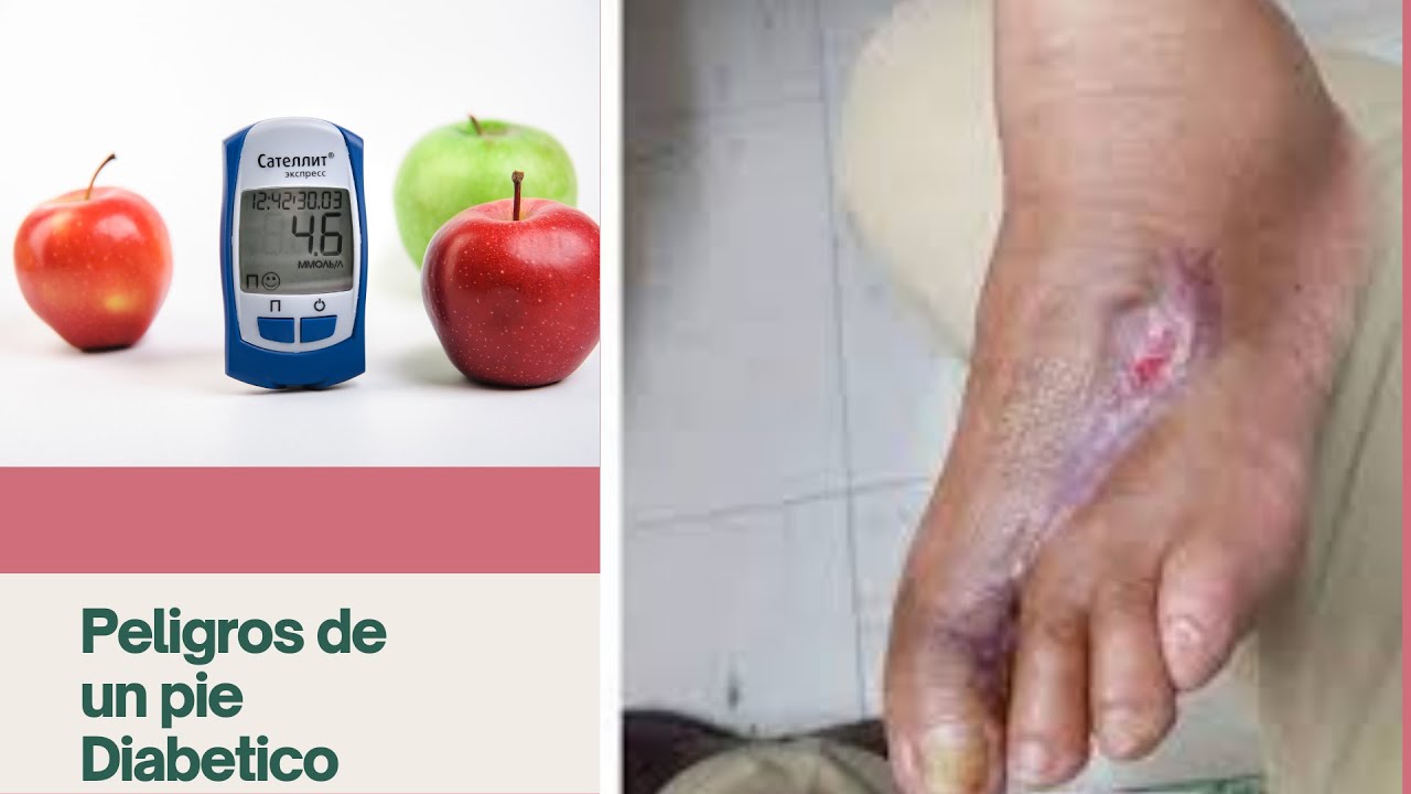 ¿Por qué se produce necrosis en el pie diabetico YouTube