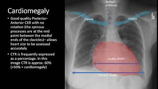 Chest X-ray Cardiac Pathologies - Radiology Medical Education - RSCP Video Curriculum