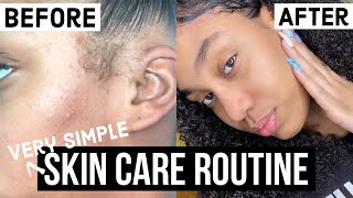 HOW I CLEARED MY PREGNANCY ACNE FAST + very simple skin routine with NATURAL products✨