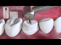 Crown preparation tutorial by Prof. Brian Millar