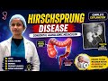 Hirschsprung Disease Complete Lecture | Signs, Diagnosis, Surgery ! Iram fatima
