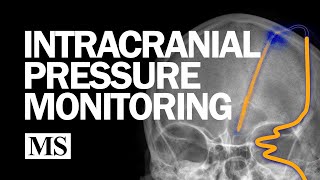 External Ventricular Drainage and Intracranial Pressure Monitoring