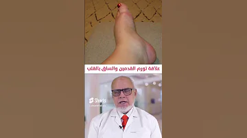 انتفاخ القدمين والساق أو تورم القدمين Edema واحتباس السوائل في الجسم دلالة خطيرة على أمراض القلب 