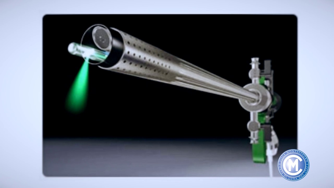 prostata ad evaporazione laser prostata ad evaporazione laser