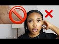 MY ACNE STORY! | HOW TO CURE YOUR ACNE ! THE DOCTORS FINALLY GAVE ME THE CURE 4 CYSTIC ACNE