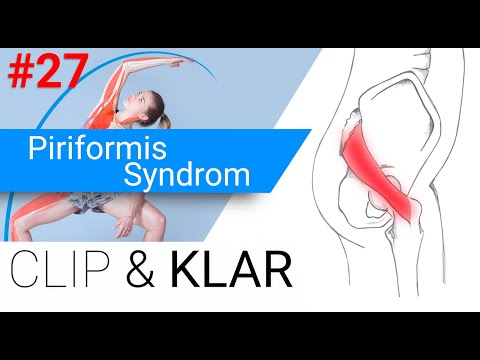 Piriformis Syndrom erklärt - Überlastung der Hüftaussenrotatoren