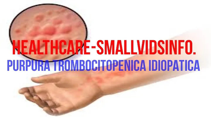 10 Helpful Tips for Purpura Trombocitopenica Idiopatica
