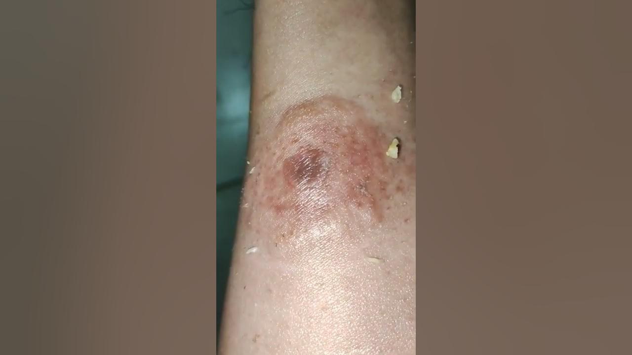 Put fresh garlic in a ring worm and this will happen. short sub ringworm garlic viral 