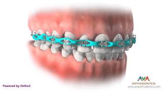 Orthodontic Treatment for Spacing - Different Stages