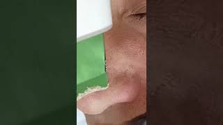 Famous Blackhead Removal with Enzyme Exfoliation | A Gentle Method Net Worth