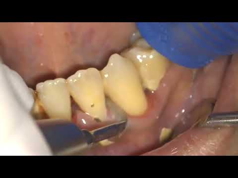 Video: Diş Taşları Nasıl Uygulanır: 14 Adım (Resimlerle)