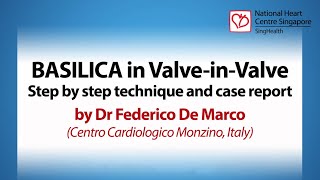 BASILICA in Valve-in-Valve: Step by Step Technique and Case Report - SingValve Lecture June 2022