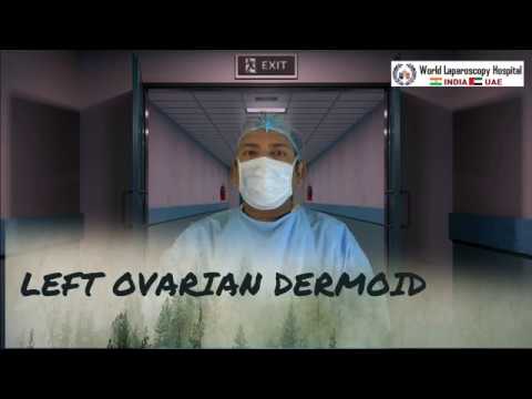 Video: Laparoscopy Of An Ovarian Cyst: How Is The Operation To Remove, The Consequences