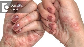 Are there any permanent & economical treatments for Psoriasis? - Dr. Aruna Prasad