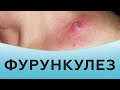 Фурункулез / Фурункулы как лечить / Причины фурункулеза