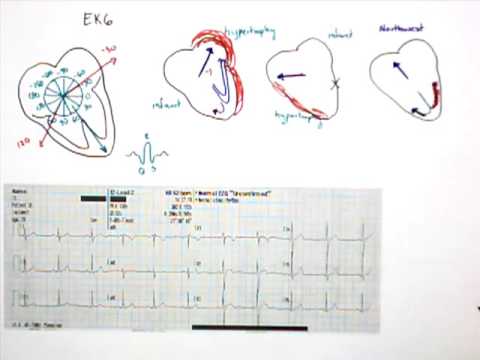 electrocardiograma 12 Lead EKG Part 5 QRS Axis
