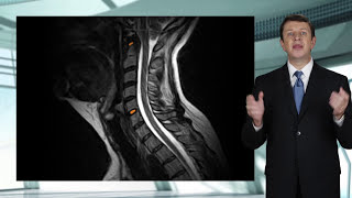 Traumatic Brain Injuries and Whiplash - Understanding the Physics and Cause of these Injuries