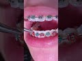 Braces on - Christmas Combination - Tooth Time Family Dentistry